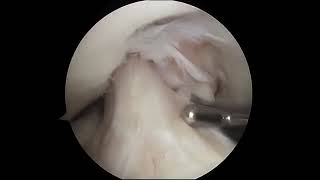 Torn Meniscus Arthroscopic Surgery [upl. by Witha943]