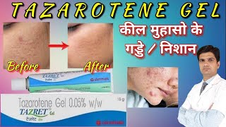 Tazarotene gel  Tazarotene cream 01  Tazarotene gel 005 reviews tazret 005 gel  tazret gel [upl. by Llevol]