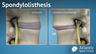 Spondylolisthesis [upl. by Doowron]