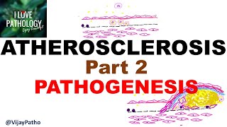 ATHEROSCLEROSIS  Part 2 Pathogenesis [upl. by Philippa52]