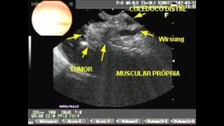 Ecoendoscopia e adenocarcinoma de papila de Vater [upl. by Nirroc697]