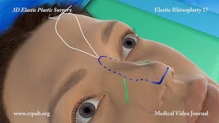 3D Elastic Rhinoplasty [upl. by Amat]