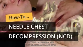 Needle Chest Decompression in TCCC [upl. by Valleau348]