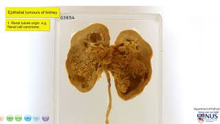 Kidney and Ureter  Urothelial Carcinoma of the Renal Pelvis [upl. by Vershen]