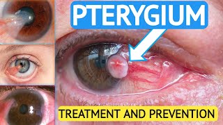 WHAT IS PTERYGIUM doctor eyes eyehealth youtube ophthalmology optometrist [upl. by Bitthia162]