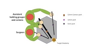 Learning Laparoscopic Sigmoid Colectomy High Anterior Resection [upl. by Nereids]