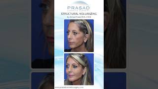 Facial Filler Technique for Bone Level Placement dermalfillers [upl. by Eirene]