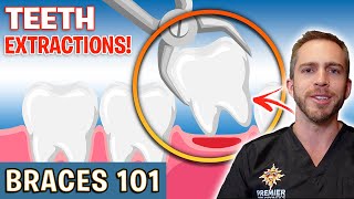 BRACES 101 Tooth Extractions For Braces  Treatment Minute Talk [upl. by Eeladnerb]