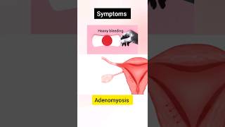 Adenomyosis shorts shortvideo viral [upl. by Adrian609]