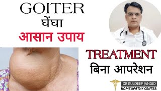 Best treatment of goiter without surgery । Cause of goiter । गलगंड का होमियोपैथी इलाज़ । [upl. by Landahl]