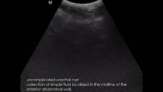 CASE 957 urachal cyst [upl. by Trubow]