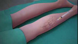 Sclerotherapy Procedure [upl. by Aube]