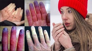 Raynauds Disease  phenomenon Tips and Proven Natural Cures [upl. by Eirbua479]