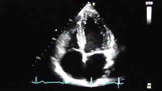 Apical 4chamber view [upl. by Jervis604]