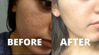 MY CO2 LASER RESURFACING TREATMENT EXPERIENCE  how to get rid of acne scars amp hyperpigmentation [upl. by Nitin]