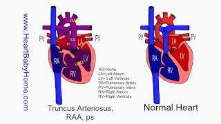 61 Truncus Arteriosus RAA ps [upl. by Awra]