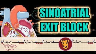 SINOATRIAL EXIT BLOCK FIRST SECOND type I type II THIRD DEGREE ECG criteria Wenckebach [upl. by Willock]