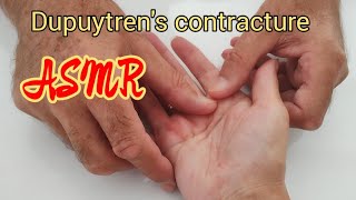 ASMR Hand massageDupuytrens contractyre asmrtherapy [upl. by Troc]