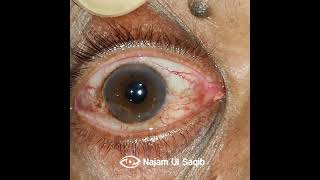 IntorsionExtorsion Of the Globe after Peribulbar Anesthesia upon attempted Extraocular movements [upl. by Rabelais527]