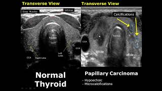 Thyroid Ultrasound Normal Vs Abnormal Image Appearances Comparison  Thyroid Pathologies USG [upl. by Bunting50]