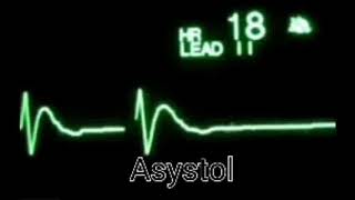 ASYSTOLE AND SVT ON ECG CLIP [upl. by Gerhardine]