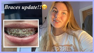 Braces update More elastics🤔⭐️🤍 [upl. by Alleunamme107]