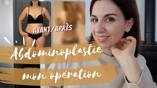 ABDOMINOPLASTIE 2 AVANTAPRÈS  OPERATION ET PREMIERE SEMAINE [upl. by Pepillo]