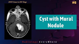 Cyst with a mural nodule  CNS lesions  Radiology cases 1000 cases in 100 days  Case No 5 [upl. by Sivi]