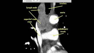 mediastinaladenopathy [upl. by Kat]