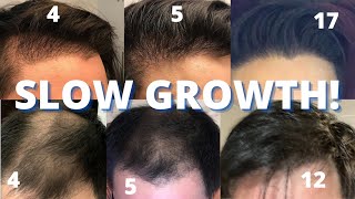 Hair Transplant Slow Growers Watch THIS [upl. by Lutero]