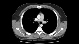 Anatomy of CT scans Thoracic cavity [upl. by Cannell]