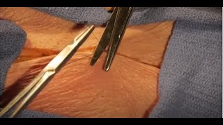 Basic Skills Sutures and Knot Tying Subcuticular Running Suture [upl. by Edik]