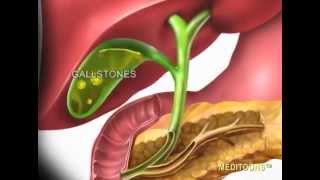 Acute Cholecystitis Gallbladder Attack Meditoons™ [upl. by Alihet812]