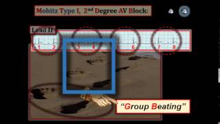 ECG Video8 Blog 105  AV Block 12512015 [upl. by Eciruam]