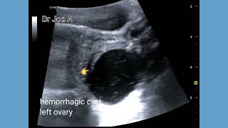 hemorrhagic cyst ovary Ultrasound and color Doppler video [upl. by Idram905]