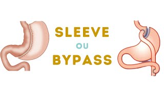 Bypass gastrique en ambulatoire à lhôpital PitiéSalpêtrière [upl. by Zacherie]