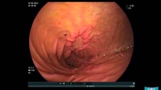 Obstructive Small Bowel Crohns Disease in Balloon Enteroscopy [upl. by Rehtae]