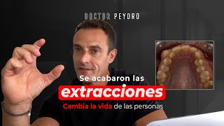 ❌🦷 Ortodoncia SIN EXTRACCIONES ¿Es posible [upl. by Elime]