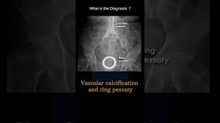 Vascular calcification amp ring pessary 13 Abdominal Xray System and anatomy radiologychannel007 [upl. by Nickey]