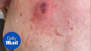 Gross moment a 25yearold cyst is popped and oozes pus [upl. by Mima]