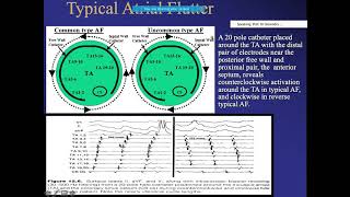 Atrial flutter  intracardiac basics and approach to ablation cardiacelectrophysiology [upl. by Ainatnas191]