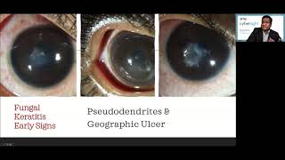 Lecture Microbial Keratitis Update for General Ophthalmologists [upl. by Ecilahc400]