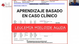 LEUCEMIA MIELOIDE AGUDA APRENDIZAJE BASADO EN CASO CLÍNICOleucemia medicina [upl. by Dorehs254]