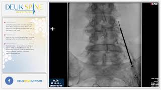 Back Treatment Deuk Laser Disc Repair  Lumbar  RT L3L5  Deuk Plasma Rhizotomy DPR  RT L3S1 [upl. by Ludmilla]