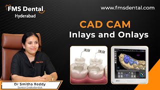 CADCAM Inlays and Onlays by Dr Smitha Reddy  FMS Dental [upl. by Link210]