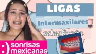 LIGAS INTERMAXILARES 😱 DUELEN Y PARA QUE SON 🤔 [upl. by Kimble]