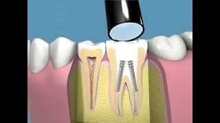 Tutti i passaggi della terapia canalare e della capsula dentale [upl. by Arjun637]