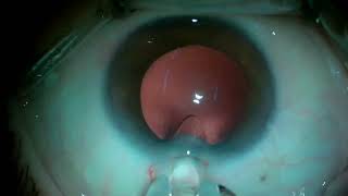 Cataract surgery with the implantation of a trifocal intraocular lens IOL assisted by femtosecond [upl. by Nirra]