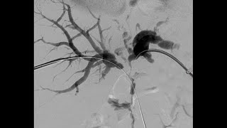 Percutaneous Transhepatic Cholangiography and Drainage PTCD [upl. by Asoramla334]