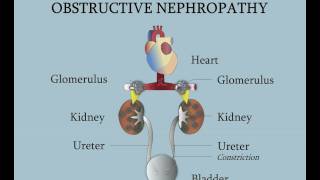 Obstrucción de la unión ureterovesical [upl. by Sutniuq]